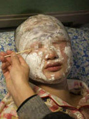 男童被泼硫酸案